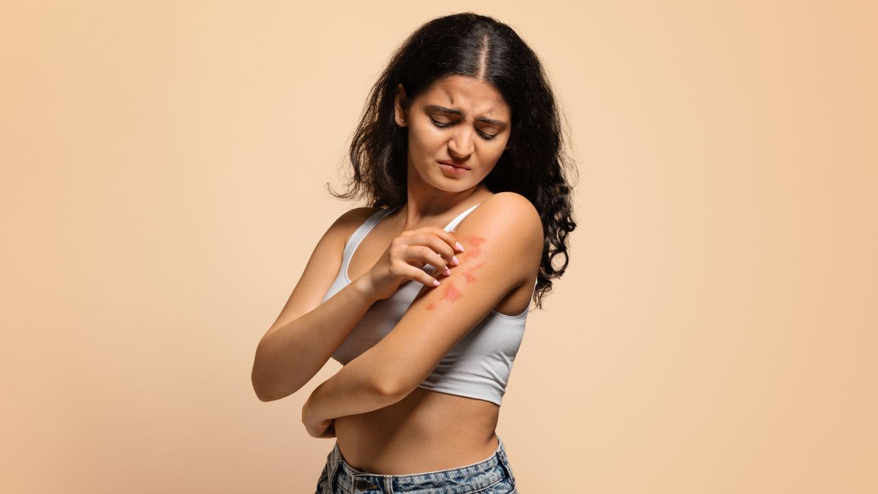 psoriáza - lupienka na ruke